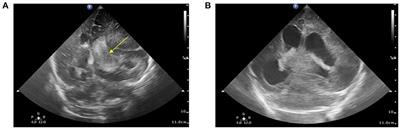 Case Report: Factor VII Deficiency Presented With Cephalohematoma After Birth